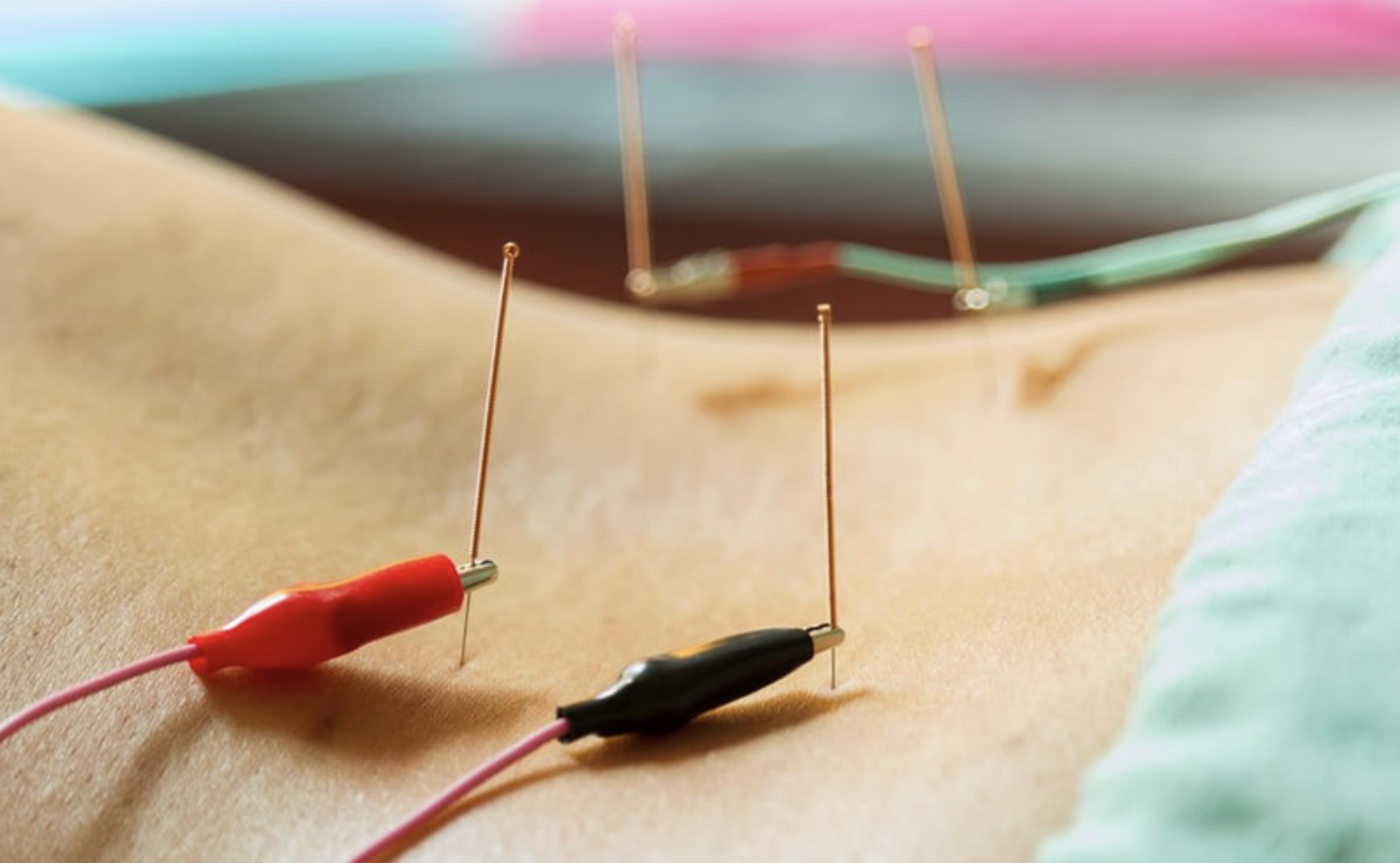 Electroacupuncture Montauban