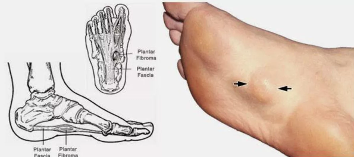 Acupuncture pour la maladie de Ledderhose - fibromatose plantaire