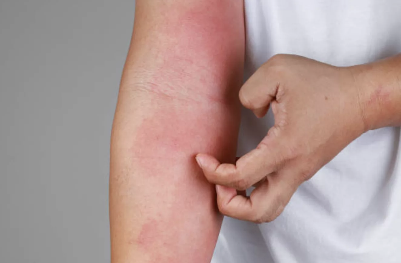 Traitement de l'eczéma par acupuncture à Montauban Tarn-et-Garonne