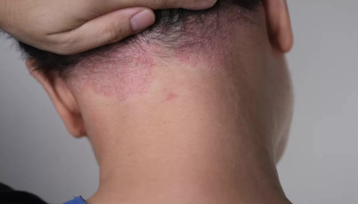 Traitement du psoriasis par acupuncture à Montauban Tarn-et-Garonne