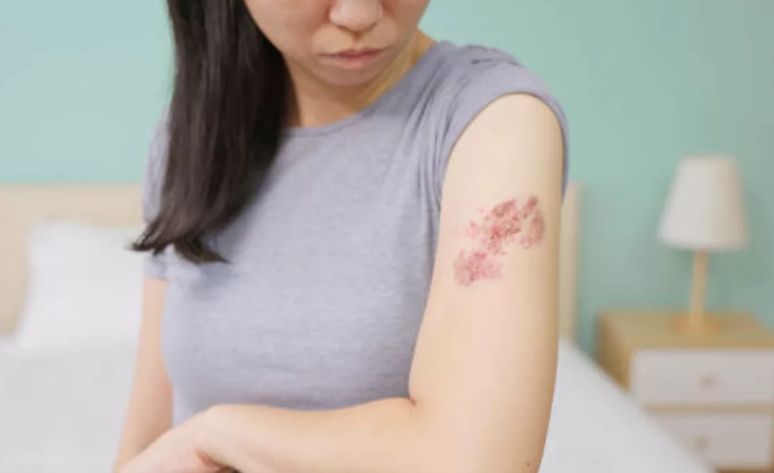 Traitement du zona par acupuncture à Montauban Tarn-et-Garonne